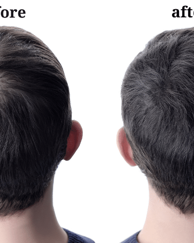 Minoxidil 5%